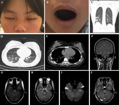 Case Report: Isolated facial and trigeminal nerve palsy without ataxia in anti-GQ1b antibody syndrome secondary to Mycoplasma pneumonia